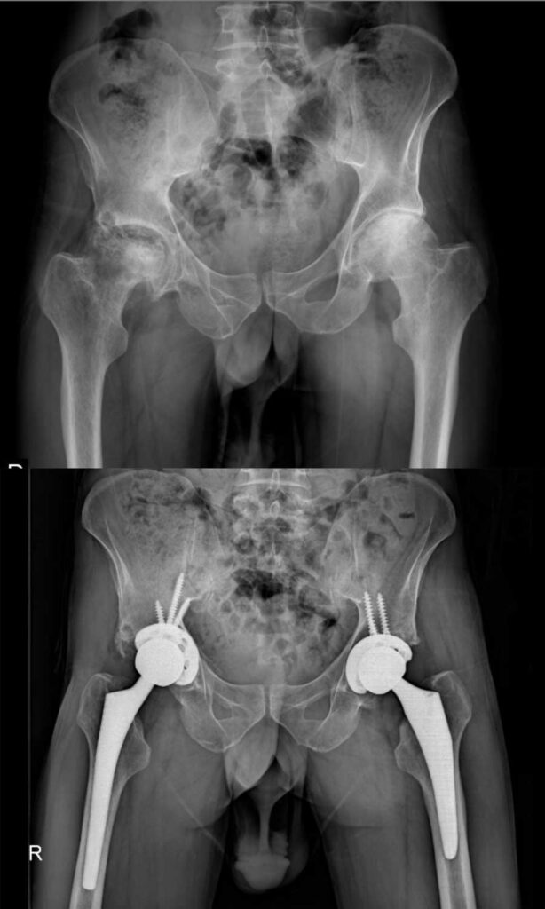 تعویض مفصل لگن بهترین راه درمان خرابی مفصل ران 43 عکس تعویض مفصل لگن