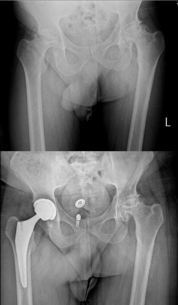 تعویض مفصل لگن بهترین راه درمان خرابی مفصل ران 44 عکس تعویض مفصل لگن