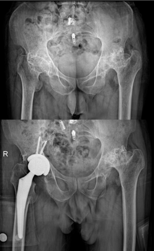 تعویض مفصل لگن بهترین راه درمان خرابی مفصل ران 45 عکس تعویض مفصل لگن