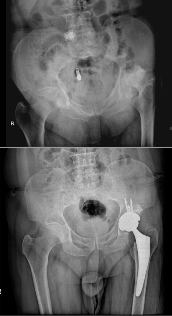 تعویض مفصل لگن بهترین راه درمان خرابی مفصل ران 35 عکس تعویض مفصل لگن