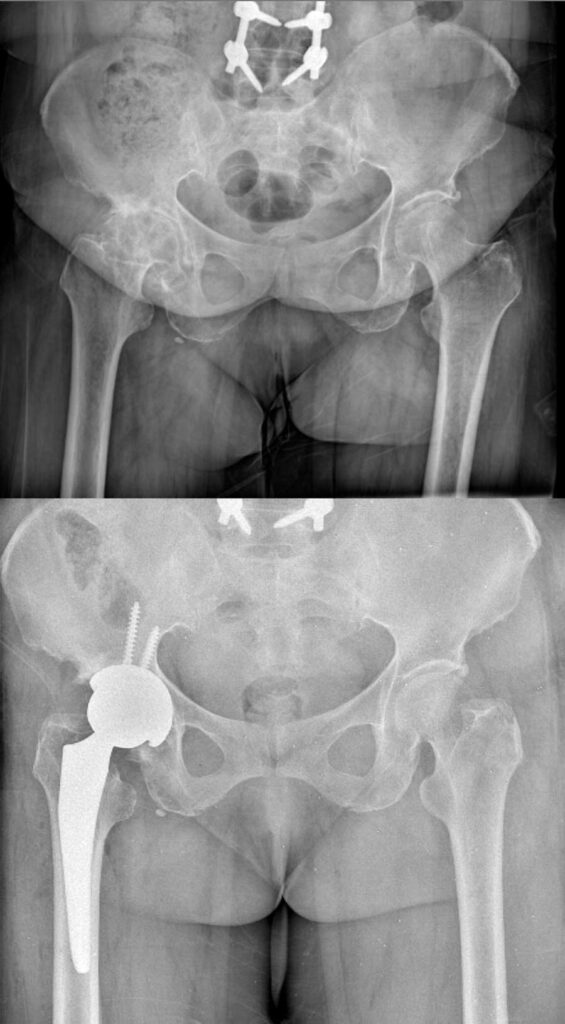 تعویض مفصل لگن بهترین راه درمان خرابی مفصل ران 36 عکس تعویض مفصل لگن