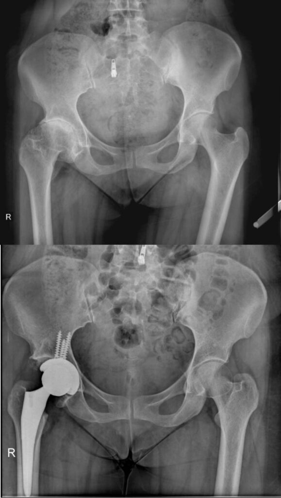 تعویض مفصل لگن بهترین راه درمان خرابی مفصل ران 37 عکس تعویض مفصل لگن
