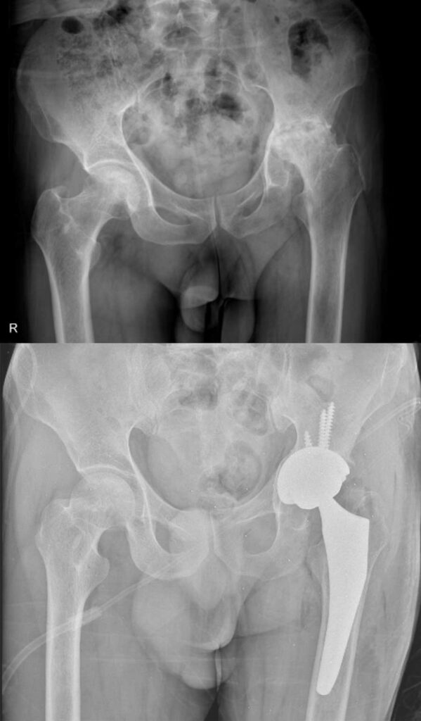 تعویض مفصل لگن بهترین راه درمان خرابی مفصل ران 38 عکس تعویض مفصل لگن