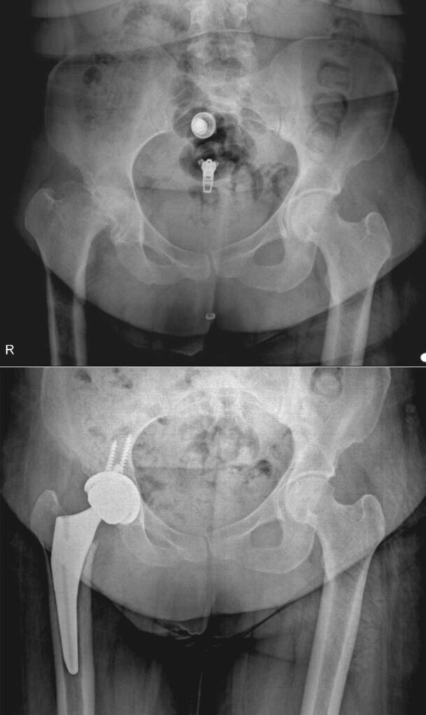 تعویض مفصل لگن بهترین راه درمان خرابی مفصل ران 39 عکس تعویض مفصل لگن