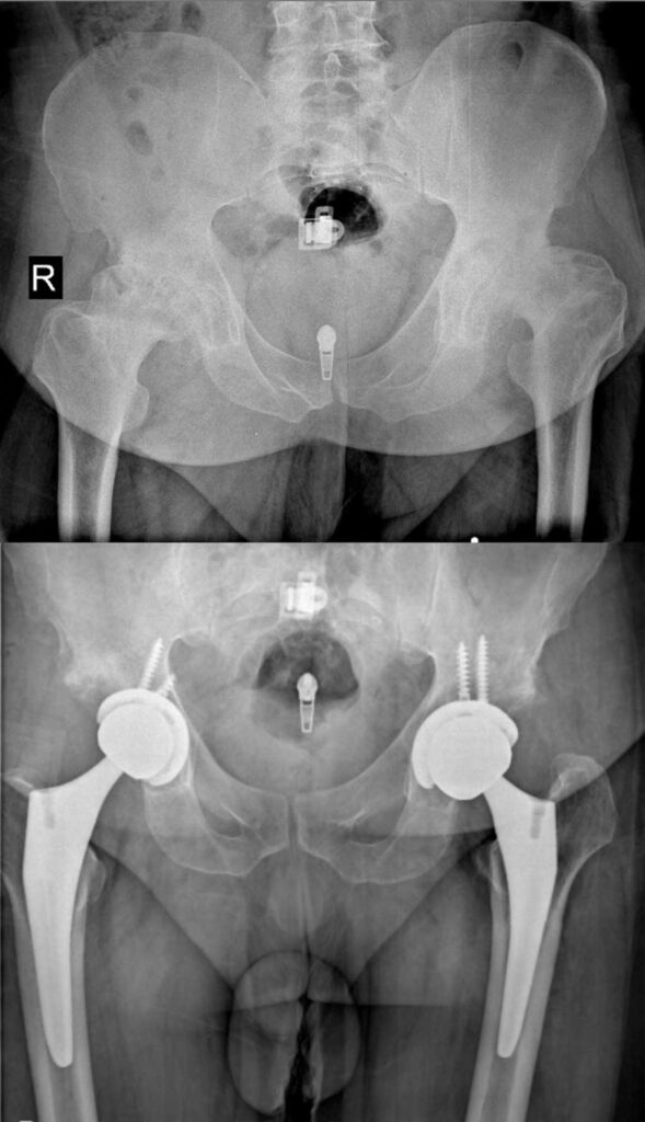 تعویض مفصل لگن بهترین راه درمان خرابی مفصل ران 40 عکس تعویض مفصل لگن