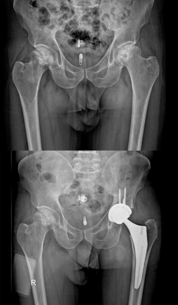 تعویض مفصل لگن بهترین راه درمان خرابی مفصل ران 41 عکس تعویض مفصل لگن