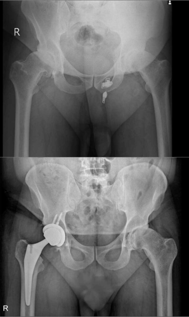 تعویض مفصل لگن بهترین راه درمان خرابی مفصل ران 42 عکس تعویض مفصل لگن