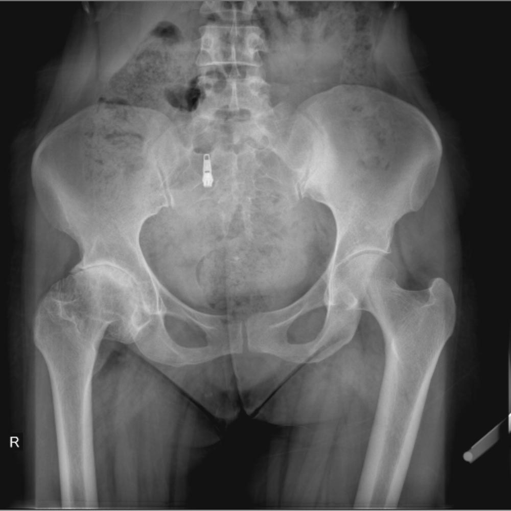 درمان آرتروز لگن و ساییدگی آن. علائم و تشخیص 28 عکس ساییدگی لگن