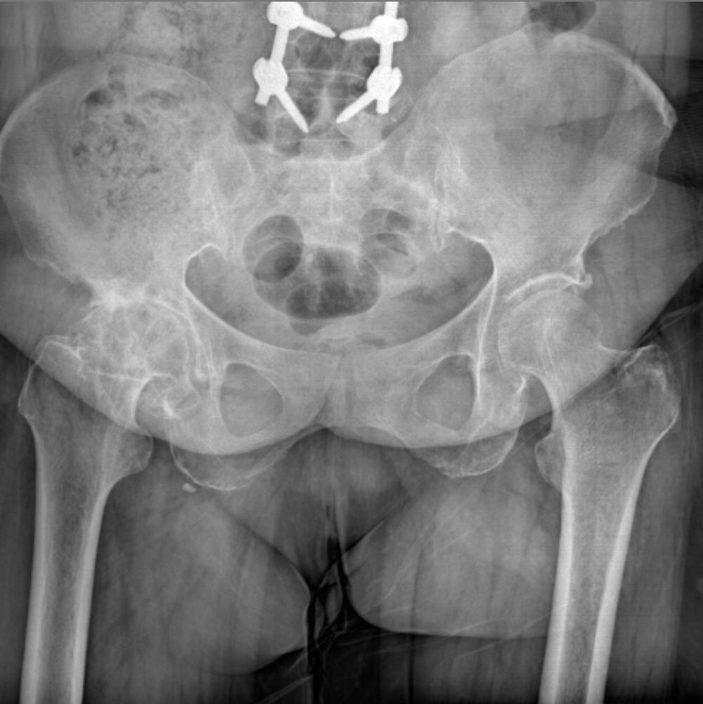 درمان آرتروز لگن و ساییدگی آن. علائم و تشخیص 27 عکس ساییدگی لگن