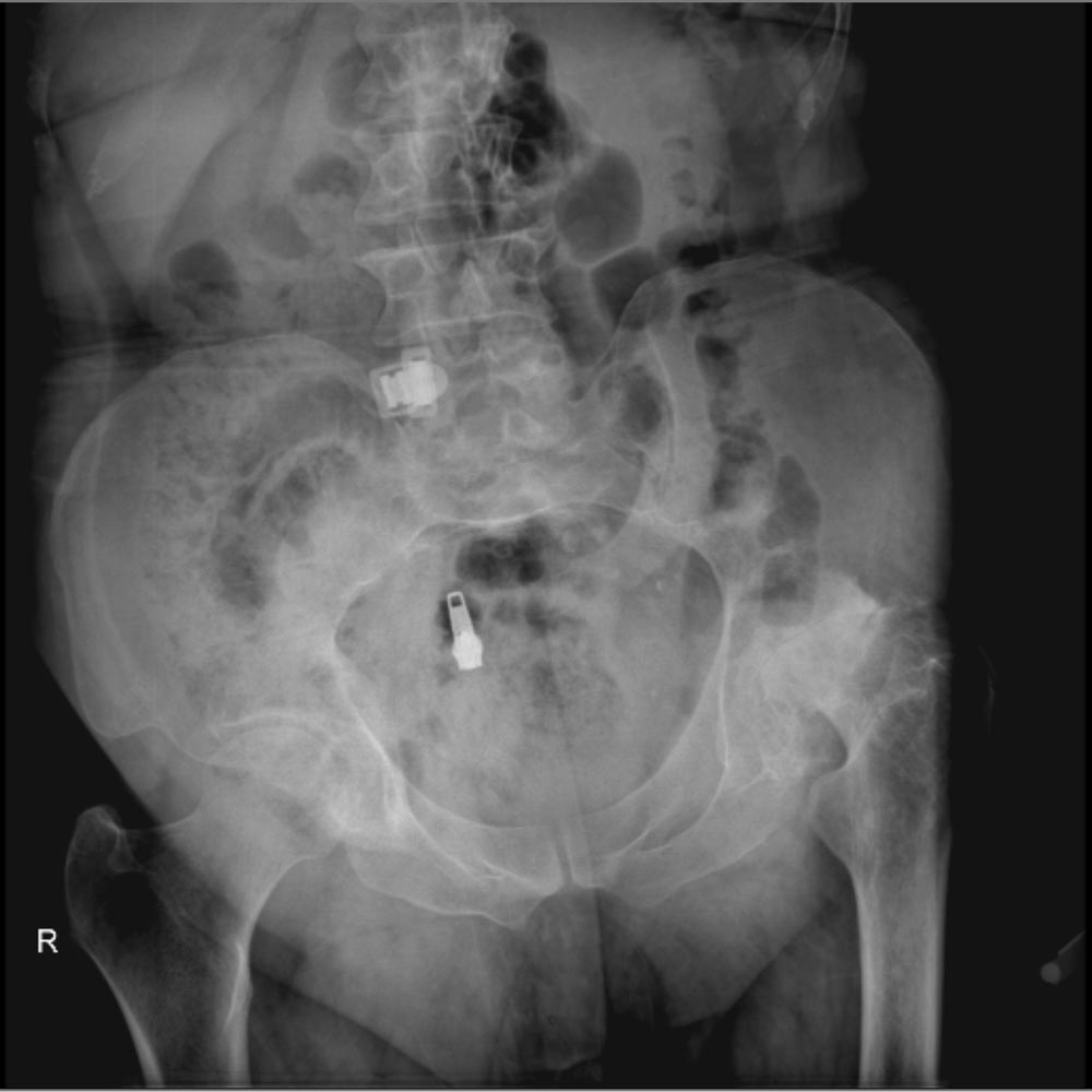 درمان آرتروز لگن و ساییدگی آن. علائم و تشخیص 26 عکس ساییدگی لگن
