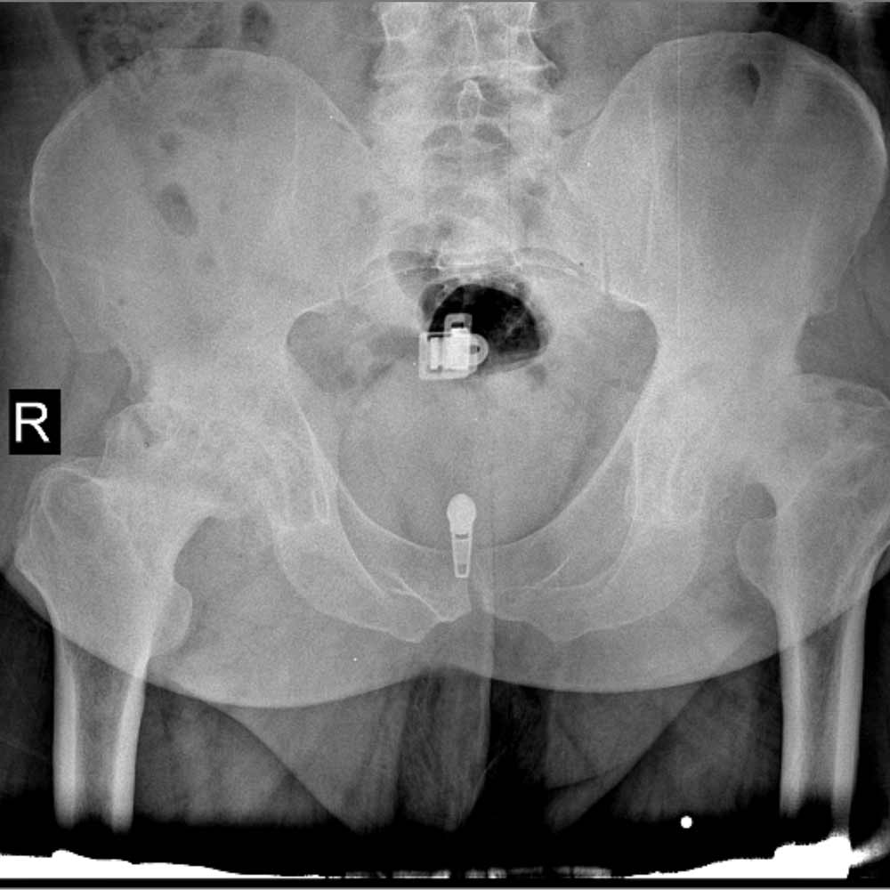 درمان آرتروز لگن و ساییدگی آن. علائم و تشخیص 25 عکس ساییدگی لگن