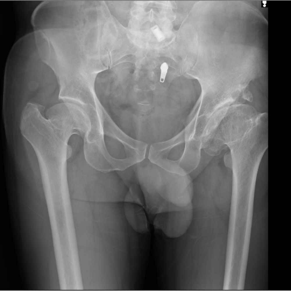 درمان آرتروز لگن و ساییدگی آن. علائم و تشخیص 24 عکس ساییدگی لگن