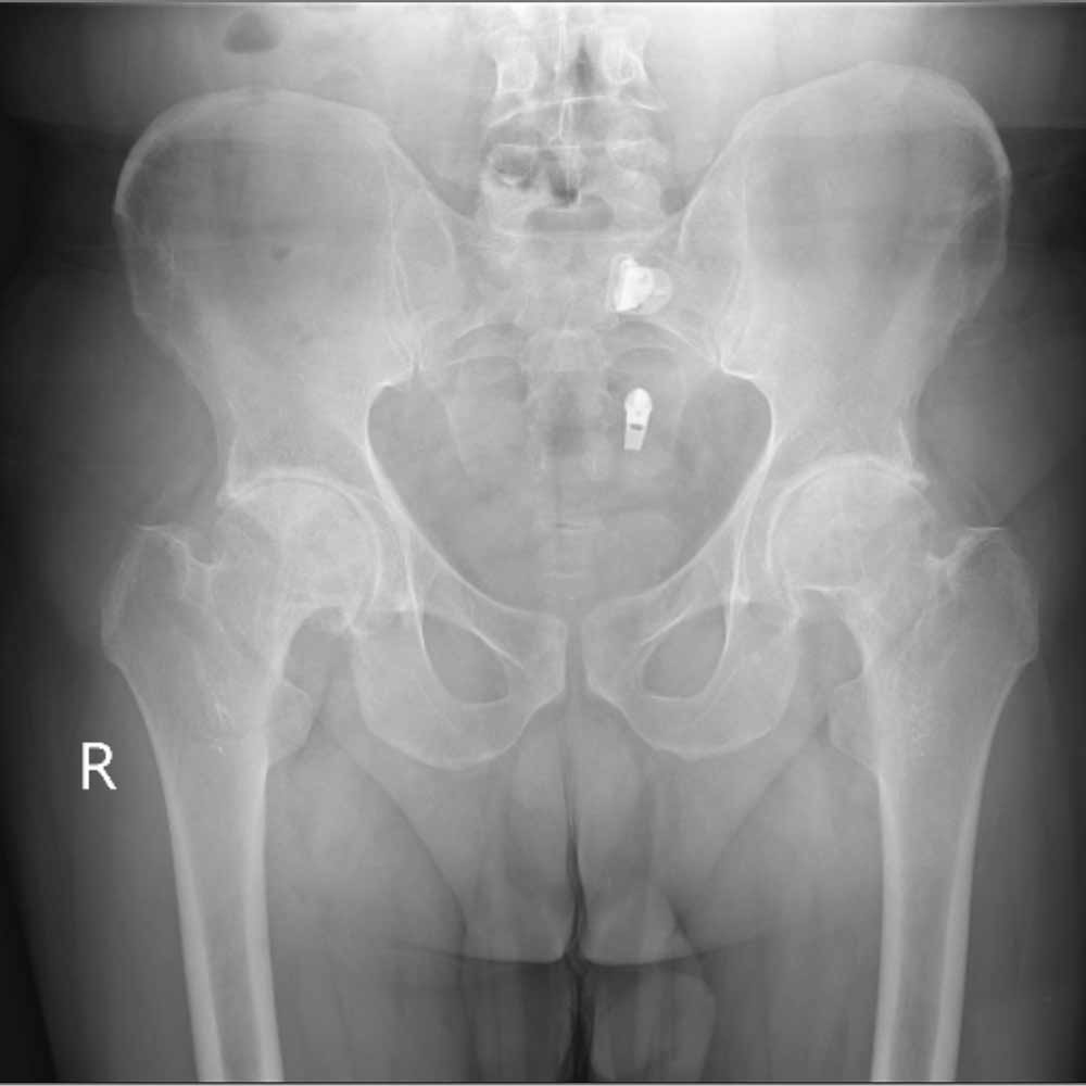 درمان آرتروز لگن و ساییدگی آن. علائم و تشخیص 23 عکس ساییدگی لگن