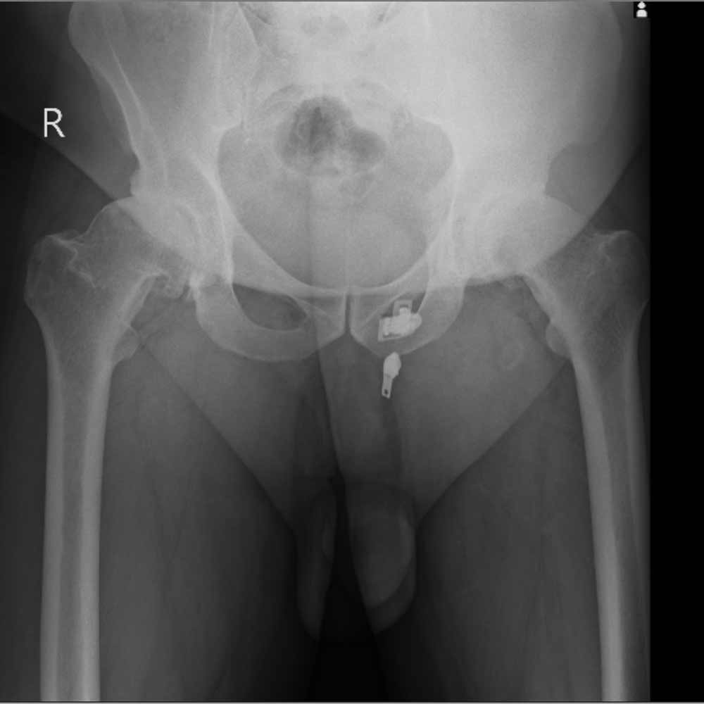 درمان آرتروز لگن و ساییدگی آن. علائم و تشخیص 22 عکس ساییدگی لگن