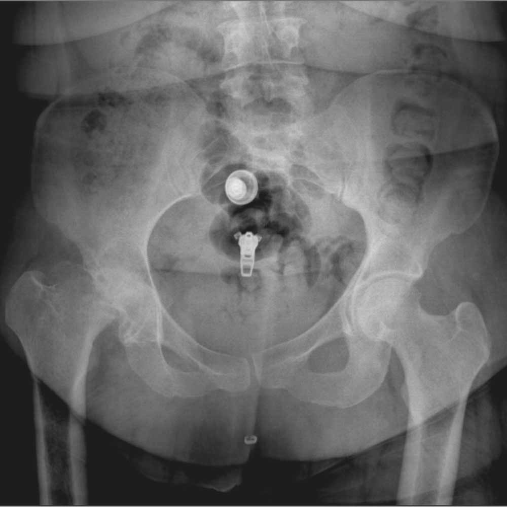 درمان آرتروز لگن و ساییدگی آن. علائم و تشخیص 21 عکس ساییدگی لگن