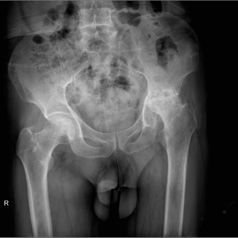 درمان آرتروز لگن و ساییدگی آن. علائم و تشخیص 29 عکس ساییدگی لگن