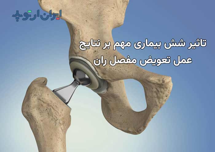 تاثیر شش بیماری بر نتایج تعویض مفصل ران