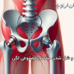 لق و شل شدن مفصل مصنوعی لگن
