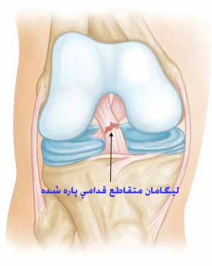 رباط صلیبی قدامی