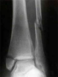  تصویر رادیوگرافی یک شکستگی دو قوزکی