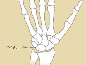 محل استخوان لونیت در مچ دست