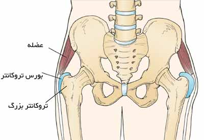 بورس تروکانتر در لگن