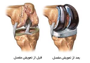 تعویض مفصل زانو