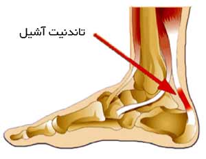 تاندنیت آشیل