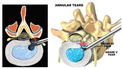 جراحی اندوسکوپی دیسک
