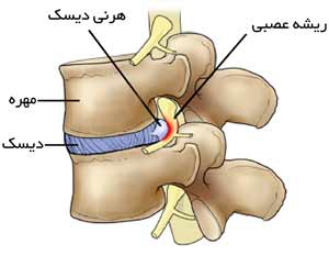 دیسک بین مهره ای