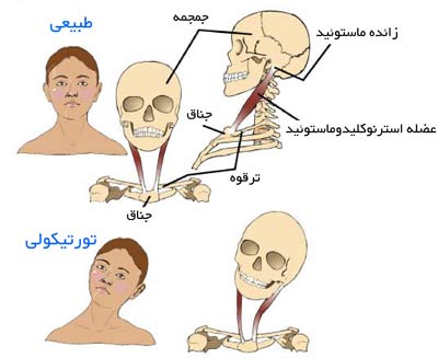 تورتیکولی