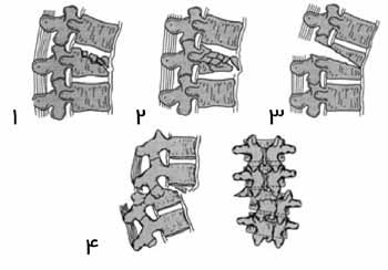 انواع شکستگی کمر
