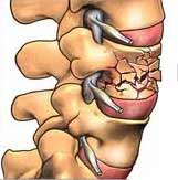 شکستگی مهره کمر