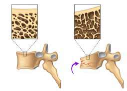 شکستگی مهره