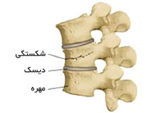 شکستگی مهره