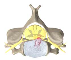  فشار دیسک به ریشه های نخاعی