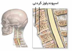  کم شدن حجم و ارتفاع دیسک