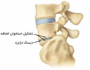 دیسک کمر