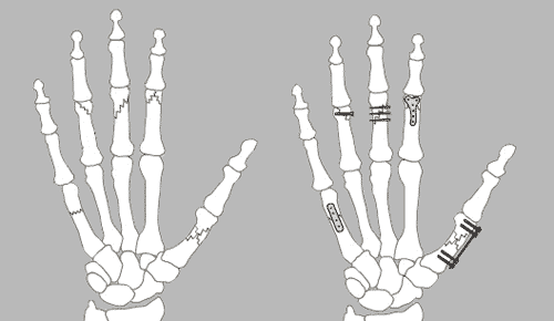جراحی انگشتان دست