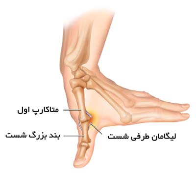 رگ به رگ شدن شست دست