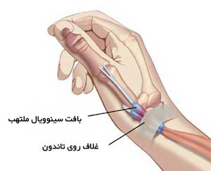 تاندون های شست در مچ دست