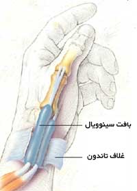 درمان جراحی بیماری دکرون