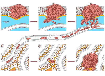 متاستاز