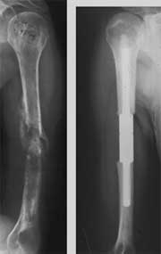  جایگزینی قسمتی از بافت تومورال استخوان بازو با وسیله فلزی