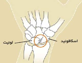 مچ دست