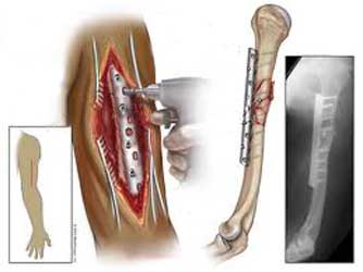  درمان جراحی شکستگی تنه بازو با پلاک