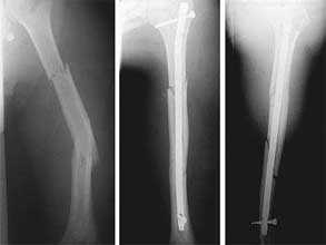  درمان شکستگی تنه استخوان بازو با میله داخل استخوانی