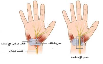 جراحی سندورم تونل کارپ