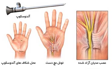 جراحی سندروم کانال مچ دستی