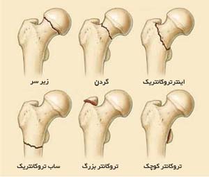 تقسیم بندی شکستگی های بالای استخوان ران در ناحیه لگن